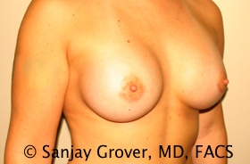 Breast Augmentation Before and After 190 | Grover Aesthetics