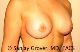 Breast Augmentation Before and After 190 | Sanjay Grover MD FACS