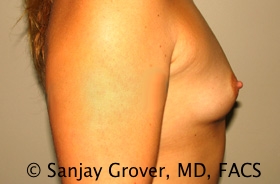 Breast Augmentation Before and After 190 | Grover Aesthetics