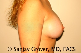 Breast Augmentation Before and After 190 | Grover Aesthetics