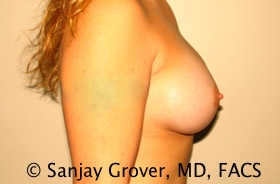 Breast Augmentation Before and After 190 | Sanjay Grover MD FACS