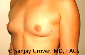Breast Augmentation Before and After 190 | Grover Aesthetics