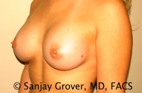 Breast Augmentation Before and After 190 | Grover Aesthetics
