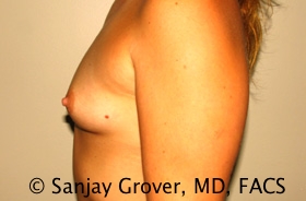 Breast Augmentation Before and After 190 | Grover Aesthetics