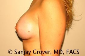 Breast Augmentation Before and After 190 | Grover Aesthetics