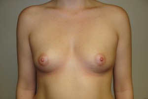Breast Augmentation Before and After | Grover Aesthetics