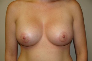 Breast Augmentation Before and After | Grover Aesthetics