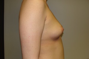 Breast Augmentation Before and After 192 | Grover Aesthetics