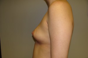 Breast Augmentation Before and After 192 | Grover Aesthetics