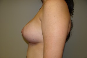Breast Augmentation Before and After 192 | Grover Aesthetics