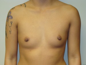 Breast Augmentation Before and After | Grover Aesthetics