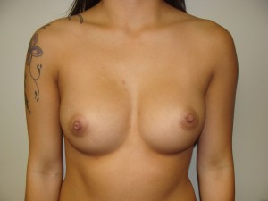 Breast Augmentation Before and After | Grover Aesthetics