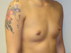 Breast Augmentation Before and After 193 | Grover Aesthetics
