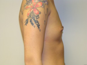 Breast Augmentation Before and After 193 | Grover Aesthetics