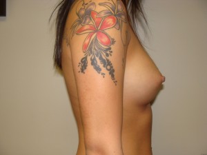 Breast Augmentation Before and After 193 | Grover Aesthetics
