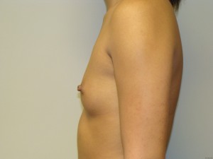 Breast Augmentation Before and After 193 | Grover Aesthetics