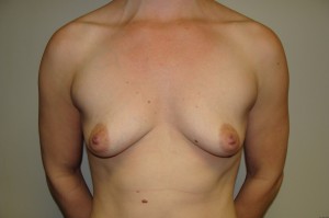 Breast Augmentation Before and After 68 | Sanjay Grover MD FACS