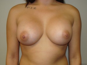Breast Augmentation Before and After | Grover Aesthetics