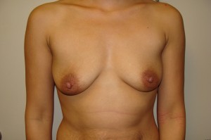 Breast Augmentation Before and After | Grover Aesthetics