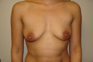 Breast Augmentation Before and After 254 | Sanjay Grover MD FACS