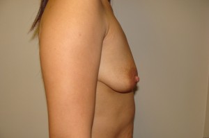 Breast Augmentation Before and After 196 | Grover Aesthetics