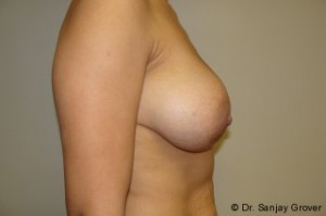 Breast Augmentation Before and After 196 | Grover Aesthetics