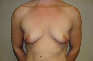 Breast Augmentation Before and After | Grover Aesthetics