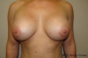 Breast Augmentation Before and After | Grover Aesthetics