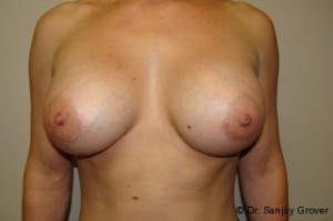 Breast Augmentation Before and After 197 | Sanjay Grover MD FACS