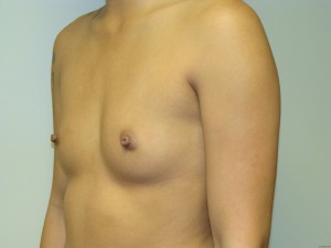 Breast Augmentation Before and After 198 | Grover Aesthetics