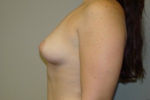 Breast Augmentation Before and After 200 | Grover Aesthetics