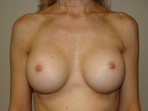Breast Augmentation Before and After | Grover Aesthetics