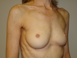 Breast Augmentation Before and After 201 | Grover Aesthetics