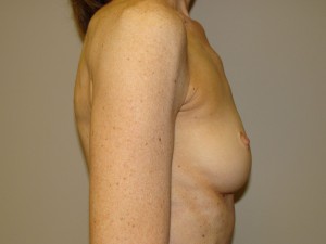 Breast Augmentation Before and After 201 | Grover Aesthetics