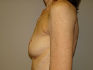 Breast Augmentation Before and After 201 | Grover Aesthetics