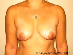 Breast Augmentation Before and After | Grover Aesthetics