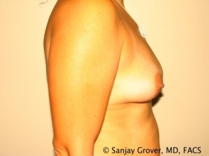 Breast Augmentation Before and After 202 | Grover Aesthetics