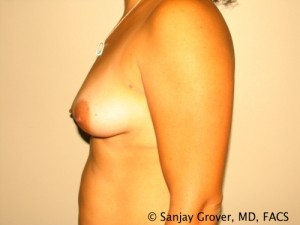 Breast Augmentation Before and After 202 | Grover Aesthetics