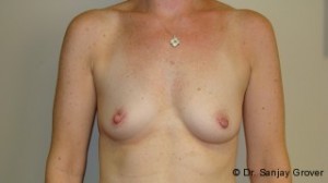 Breast Augmentation Before and After 261 | Sanjay Grover MD FACS