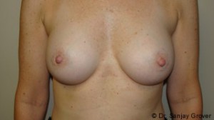 Breast Augmentation Before and After | Grover Aesthetics