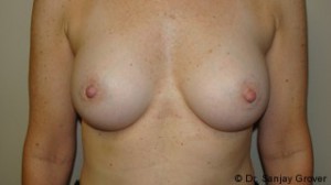 Breast Augmentation Before and After 205 | Sanjay Grover MD FACS