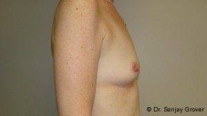Breast Augmentation Before and After 205 | Grover Aesthetics