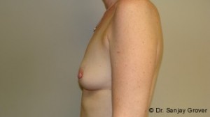 Breast Augmentation Before and After 205 | Grover Aesthetics