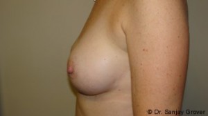 Breast Augmentation Before and After 205 | Grover Aesthetics