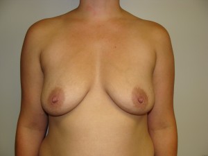 Breast Augmentation Before and After | Grover Aesthetics