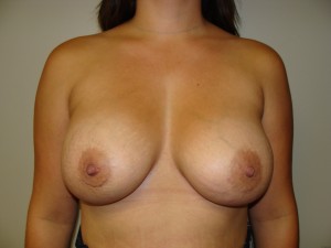Breast Augmentation Before and After | Grover Aesthetics