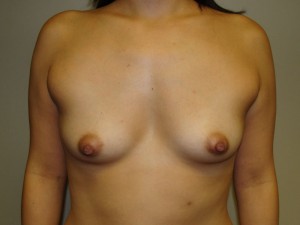 Breast Augmentation Before and After | Grover Aesthetics