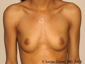 Breast Augmentation Before and After | Grover Aesthetics