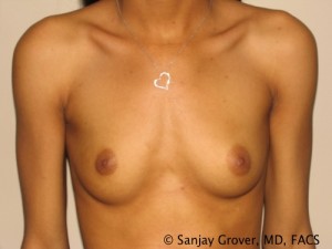 Breast Augmentation Before and After 163 | Sanjay Grover MD FACS