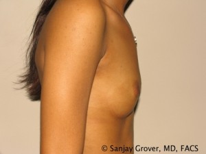 Breast Augmentation Before and After 21 | Grover Aesthetics